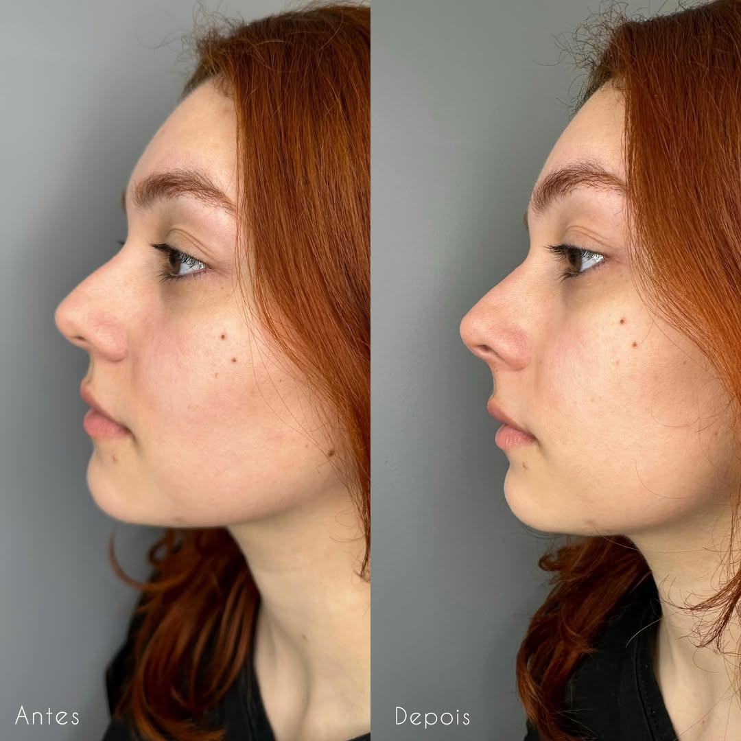 Rinomodelação — antes e depois